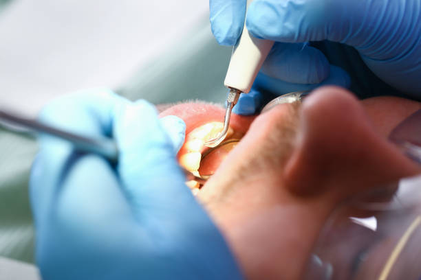 Best Emergency Root Canal Treatment in Oak Grove, LA